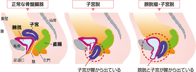 home vol.55：「骨盤臓器脱」とはどんな病気？｜お知らせ｜静岡済生会
