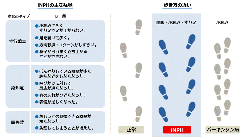 サインを見逃すな!脳・神経の病気「正常圧水頭症」 - きょうの